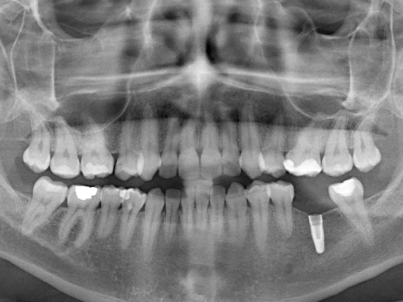 Single Implant With Angulated Peek Abutment 3