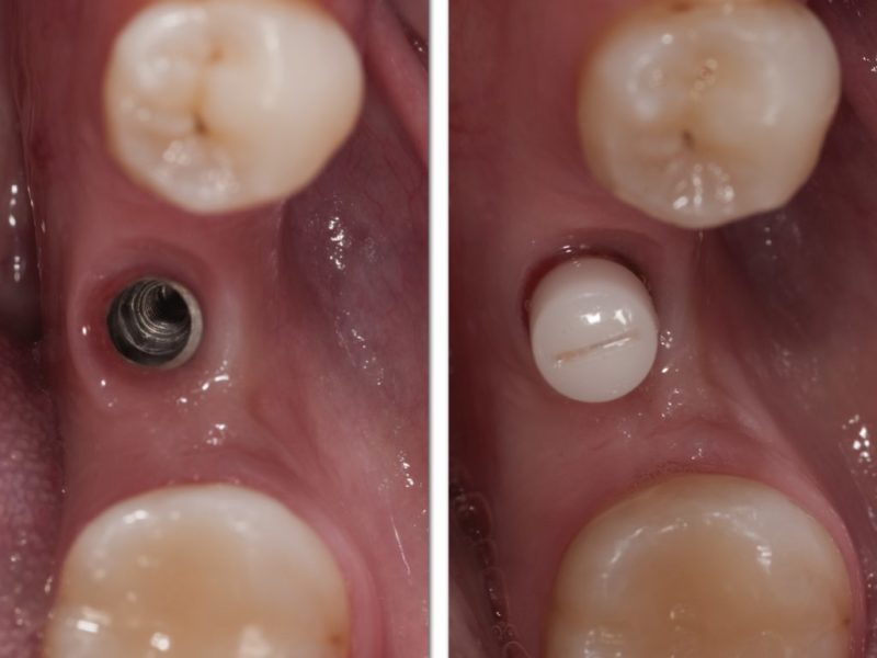 Single Implant With Angulated Peek Abutment