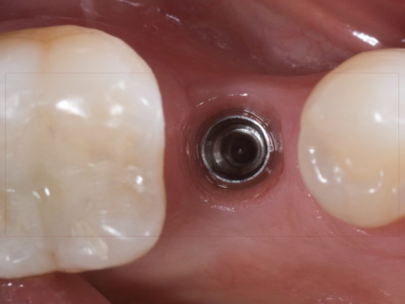 Single Tooth Restoration With Cerec System