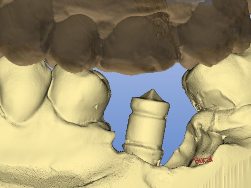Single Tooth Restoration With Cerec System